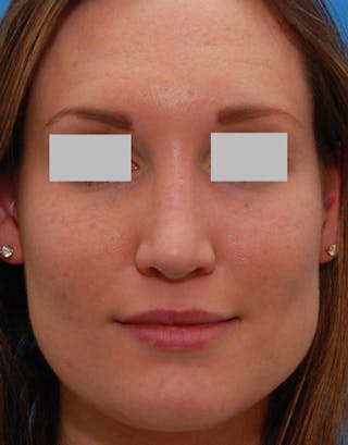 Rhinoplasty Before & After Gallery - Patient 262217 - Image 4