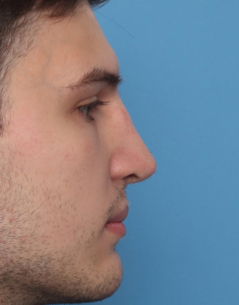 Male Rhinoplasty Before & After Gallery - Patient 327028 - Image 2