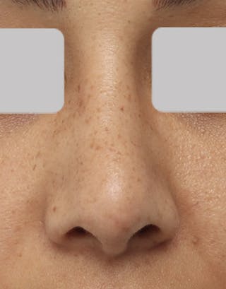 Rhinoplasty Before & After Gallery - Patient 359657 - Image 2