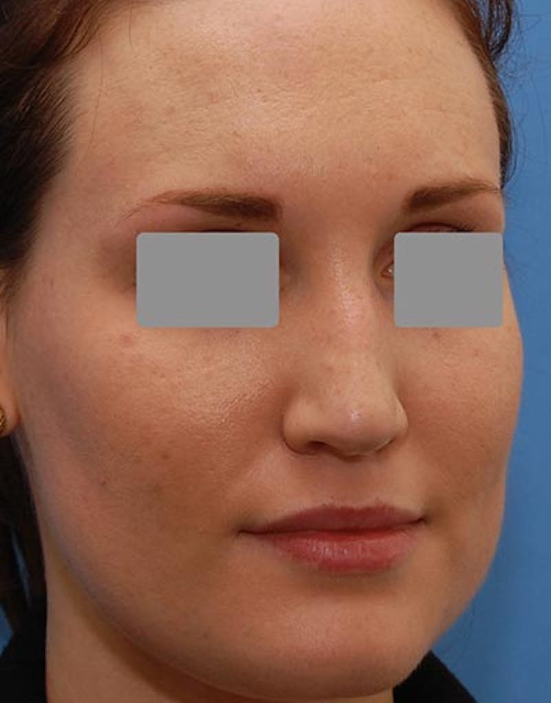 Rhinoplasty Before & After Gallery - Patient 974055 - Image 5
