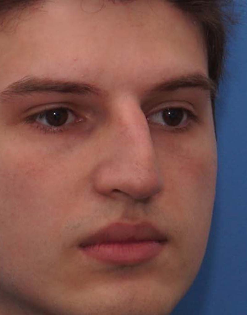 Rhinoplasty  Before & After Gallery - Patient 275782 - Image 3