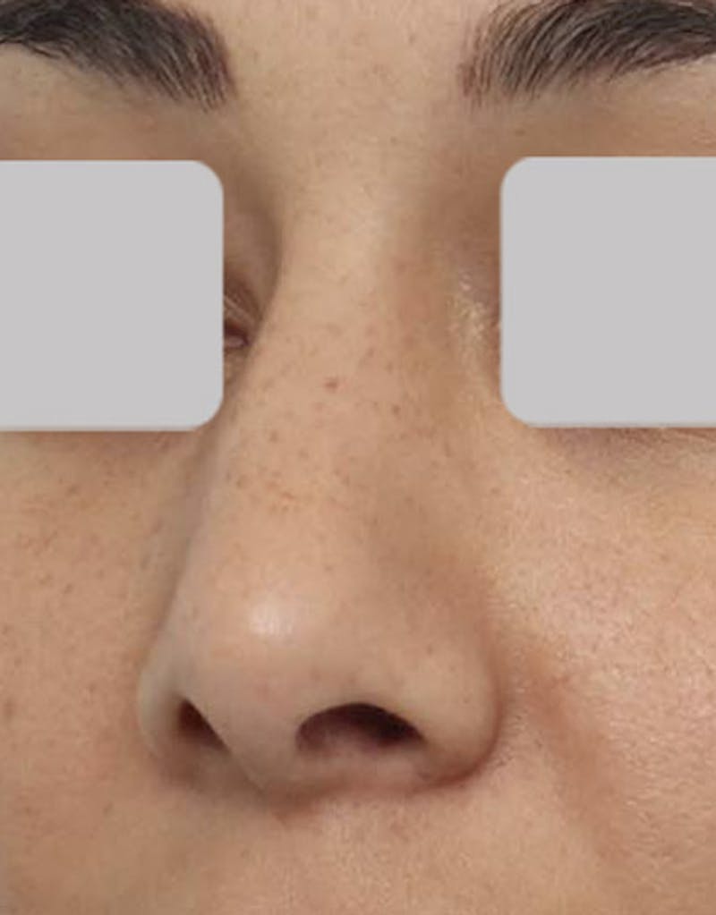 Revision Rhinoplasty Before & After Gallery - Patient 170048 - Image 3