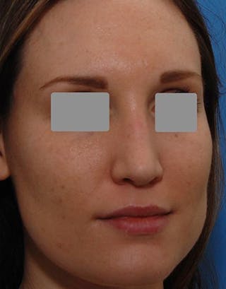 Rhinoplasty Before & After Gallery - Patient 262217 - Image 6