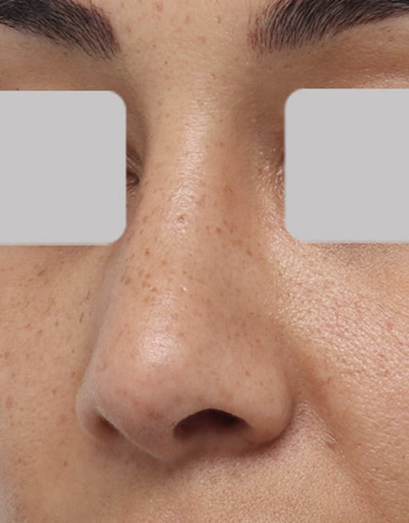 Revision Rhinoplasty Before & After Gallery - Patient 170048 - Image 4
