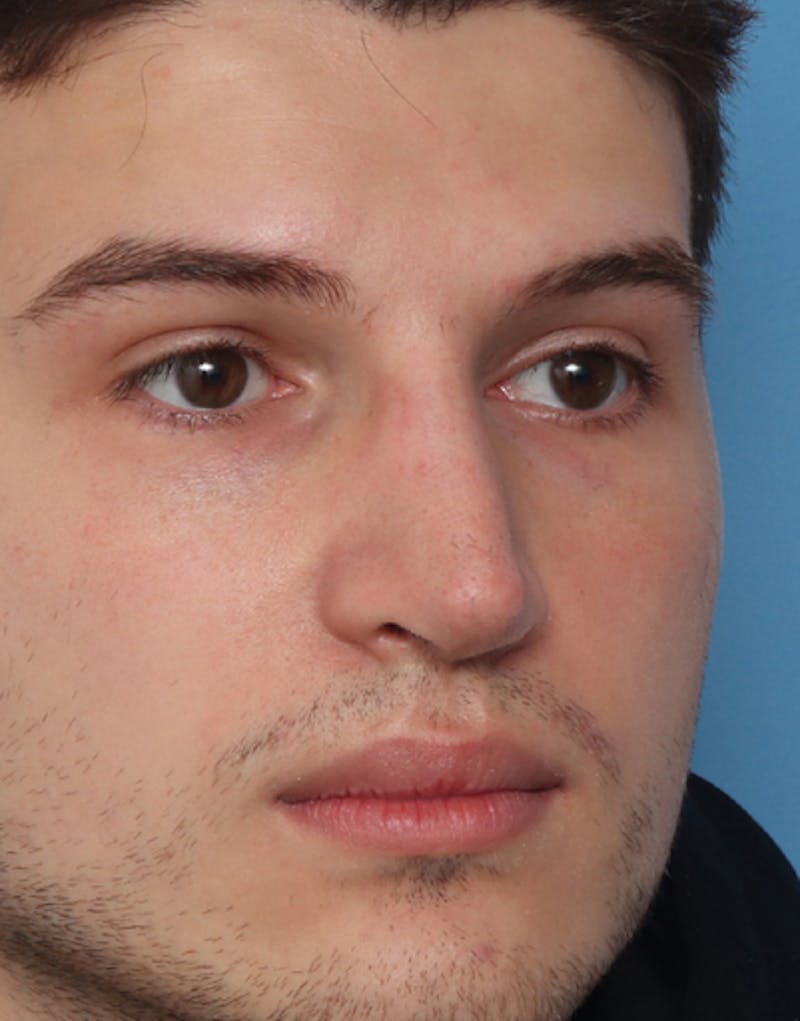 Rhinoplasty  Before & After Gallery - Patient 275782 - Image 4