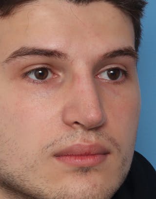 Rhinoplasty Before & After Gallery - Patient 275782 - Image 4
