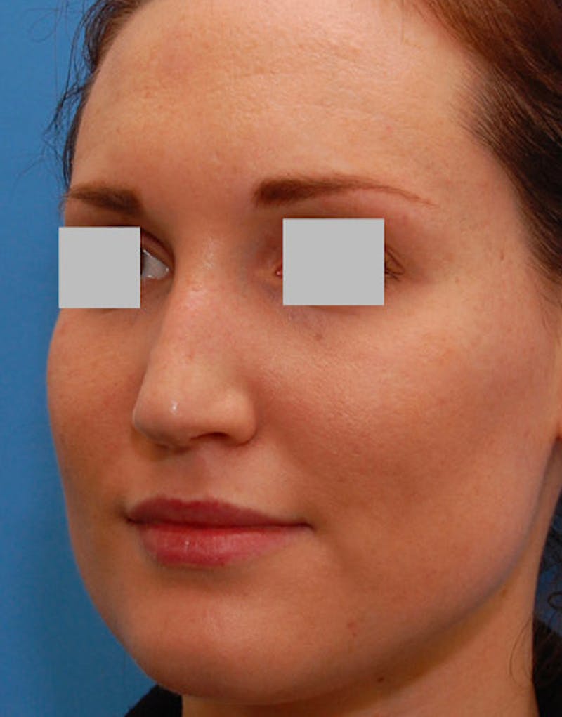 Rhinoplasty  Before & After Gallery - Patient 262217 - Image 7