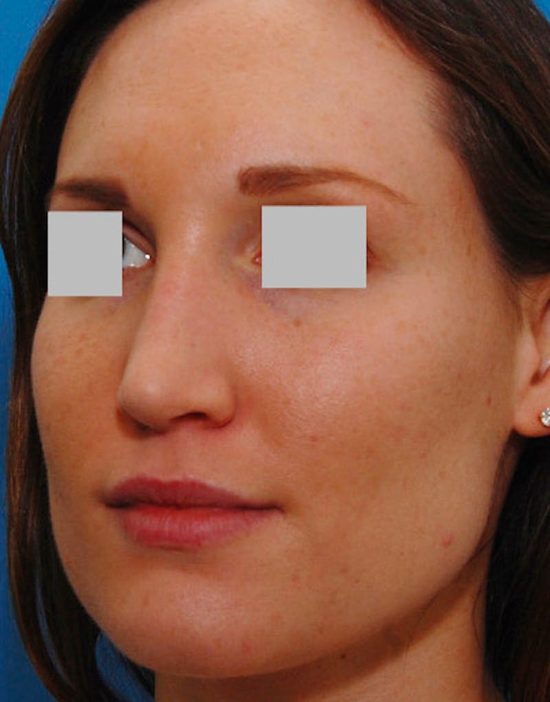 Rhinoplasty  Before & After Gallery - Patient 262217 - Image 8