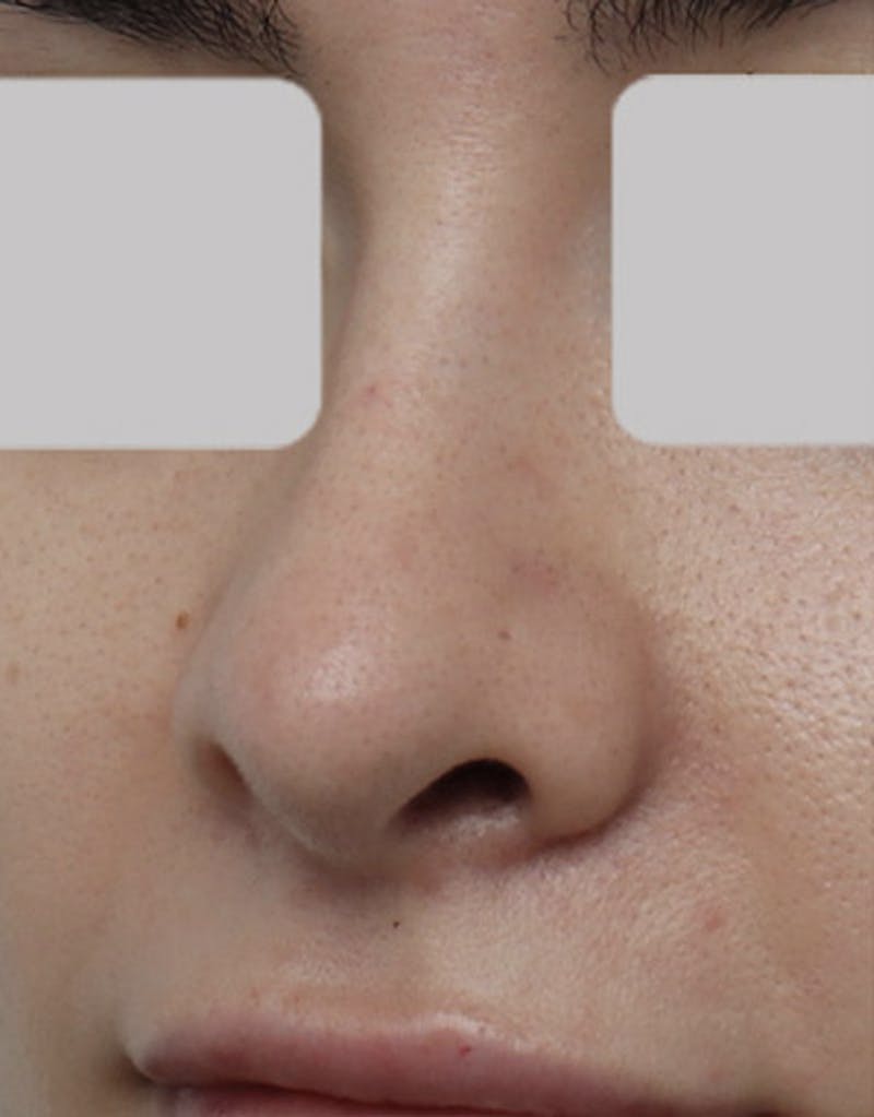 Patient Bpcu_pBNSoWHpUEgrxZ0Kg - Revision Rhinoplasty Before & After Photos