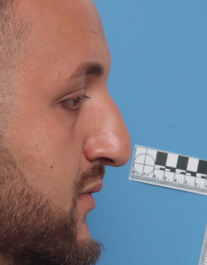 Patient VEvUTaupQzyIjCJPxaEw1w - Male Rhinoplasty Before & After Photos