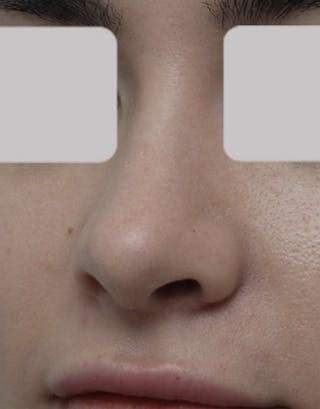 Rhinoplasty Before & After Gallery - Patient 137636 - Image 2