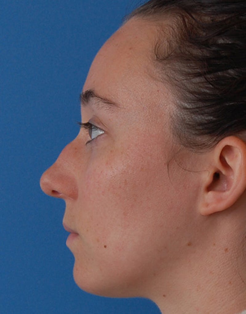 Rhinoplasty Before & After Gallery - Patient 974055 - Image 9