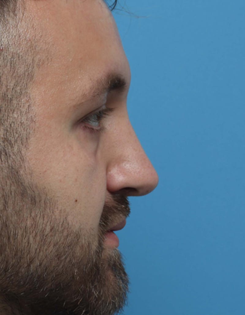 Male Rhinoplasty Before & After Gallery - Patient 208685 - Image 2