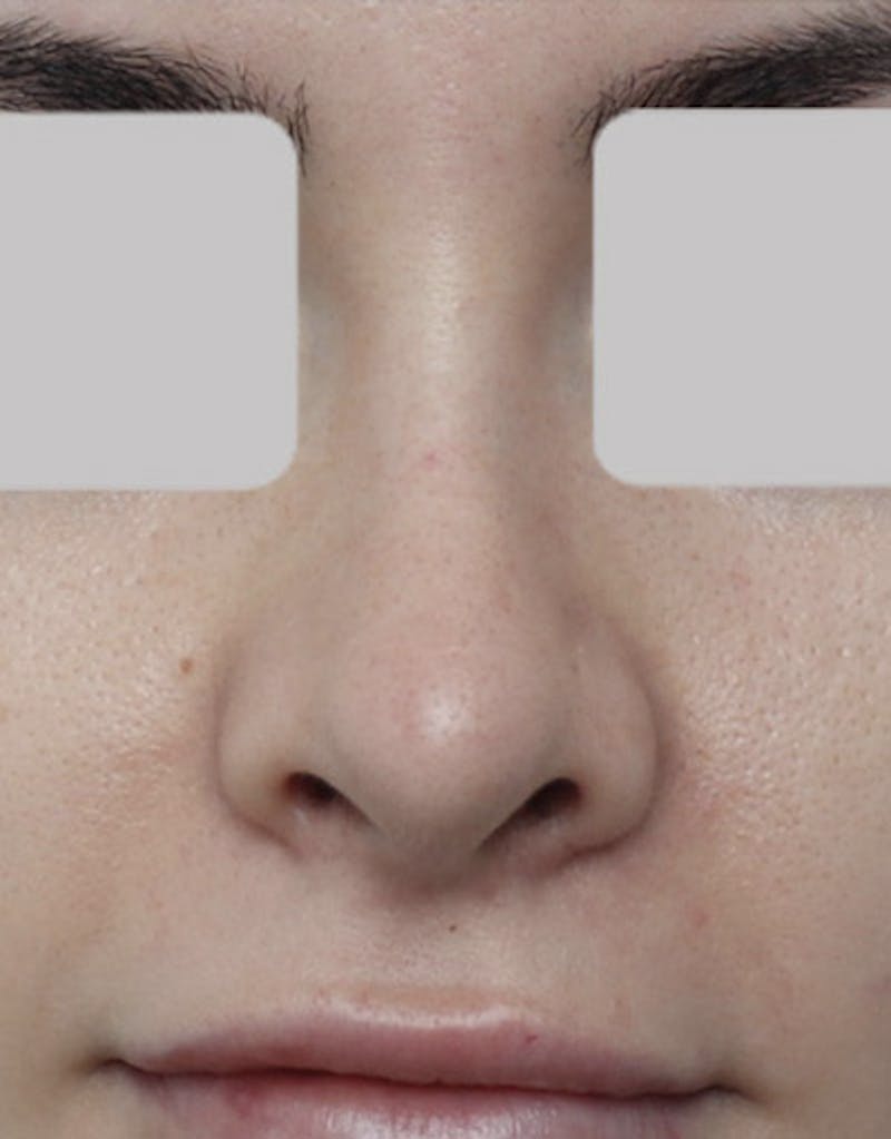 Revision Rhinoplasty Before & After Gallery - Patient 194626 - Image 3