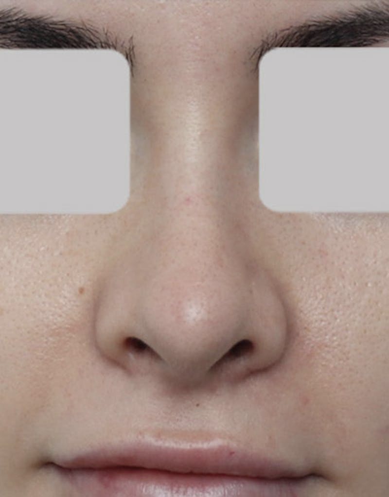 Rhinoplasty  Before & After Gallery - Patient 137636 - Image 3