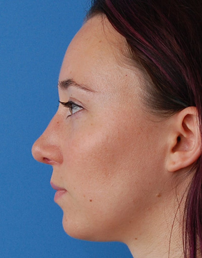 Rhinoplasty Before & After Gallery - Patient 974055 - Image 10