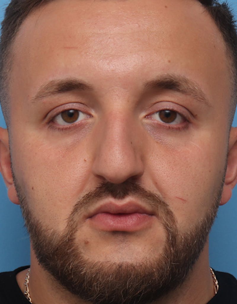 Rhinoplasty  Before & After Gallery - Patient 223364 - Image 3