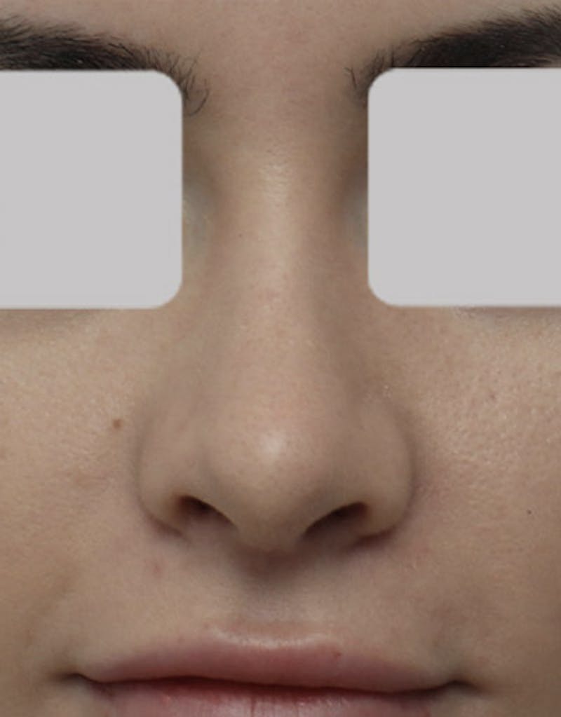 Revision Rhinoplasty Before & After Gallery - Patient 194626 - Image 4