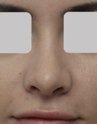 Rhinoplasty Before & After Gallery - Patient 137636 - Image 4
