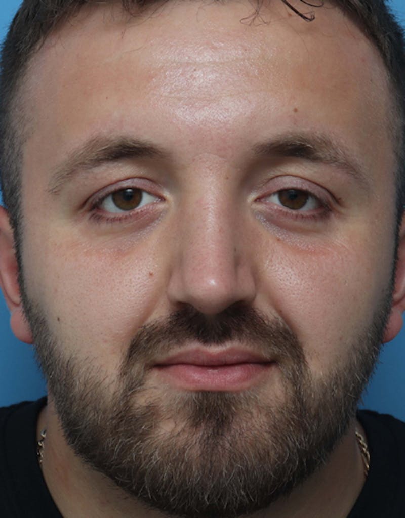 Rhinoplasty  Before & After Gallery - Patient 223364 - Image 4