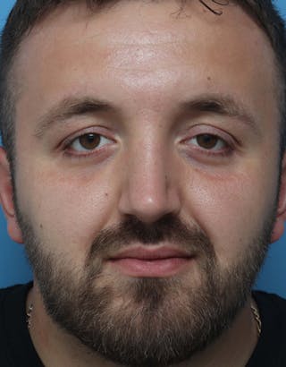 Rhinoplasty Before & After Gallery - Patient 223364 - Image 4