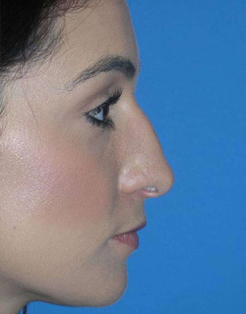 Rhinoplasty Before & After Gallery - Patient 347811 - Image 1