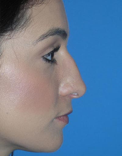 Rhinoplasty Before & After Gallery - Patient 199865 - Image 1