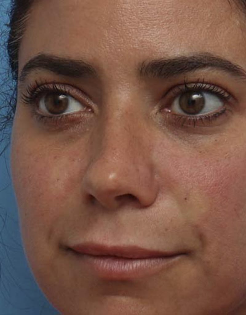 Patient Eq5tZinvRbGQMbpWFH3bqQ - Revision Rhinoplasty Before & After Photos
