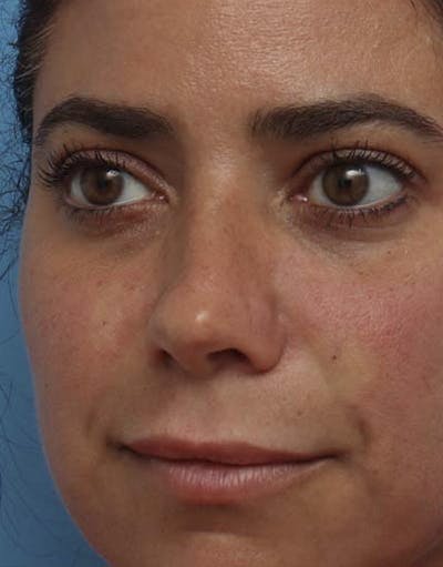 Rhinoplasty Before & After Gallery - Patient 113295 - Image 1