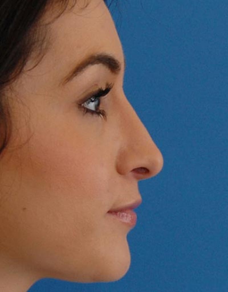 Rhinoplasty Before & After Gallery - Patient 347811 - Image 2