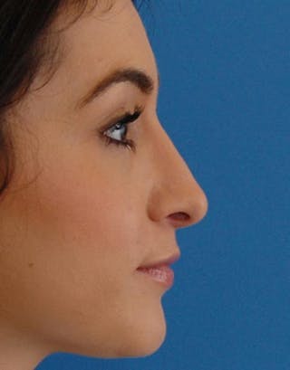 Rhinoplasty Before & After Gallery - Patient 199865 - Image 2