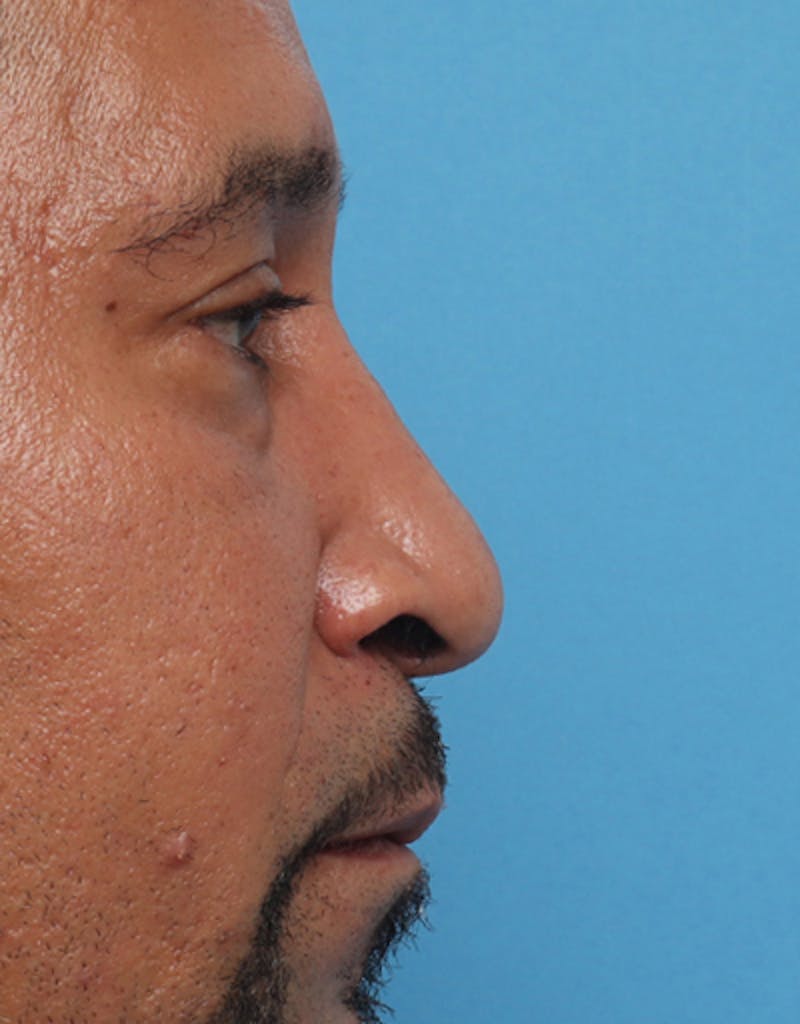 Patient Oz2dI9CHQbGmLSzdseKIbA - Male Rhinoplasty Before & After Photos