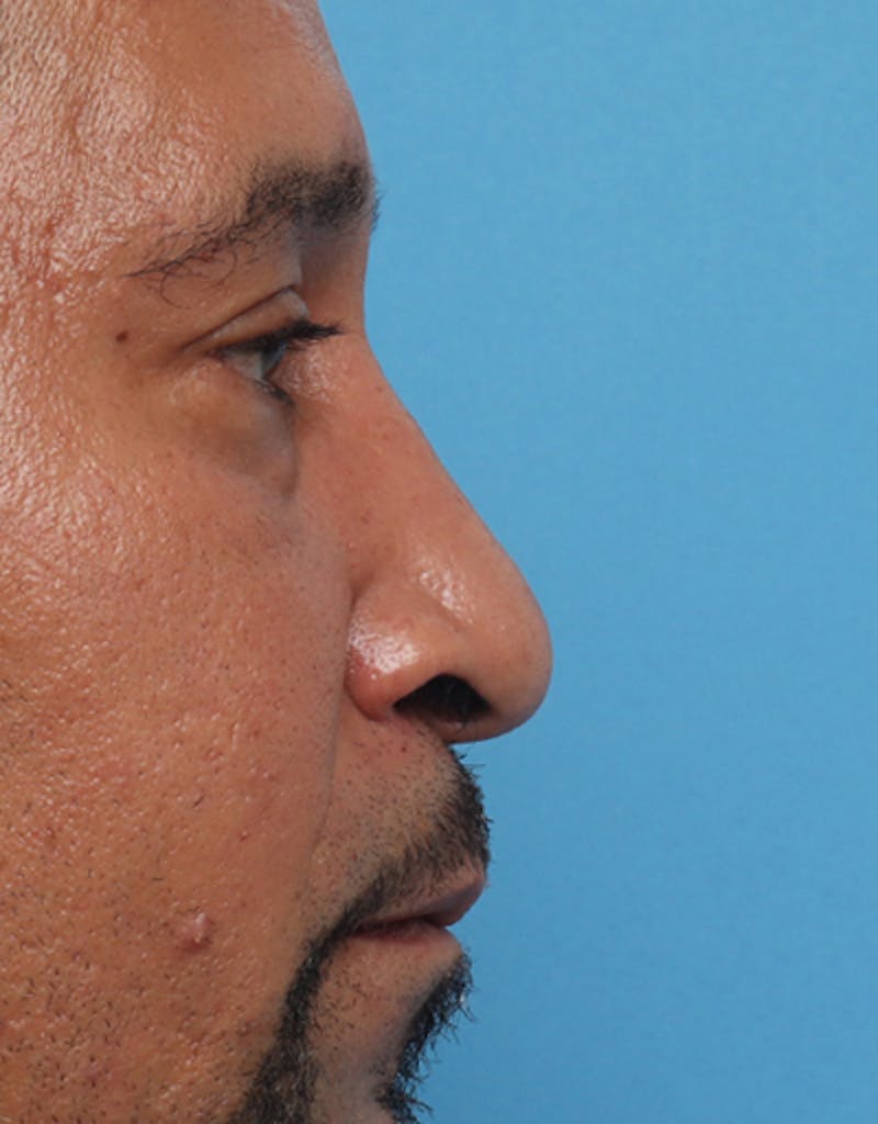 Patient DzULnxy9ToKH_Gqisq2ugA - Male Rhinoplasty Before & After Photos