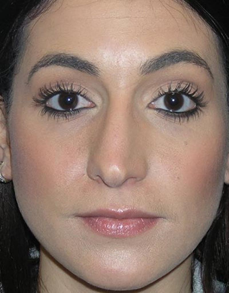 Rhinoplasty  Before & After Gallery - Patient 199865 - Image 3