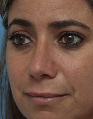 Rhinoplasty Before & After Gallery - Patient 113295 - Image 2