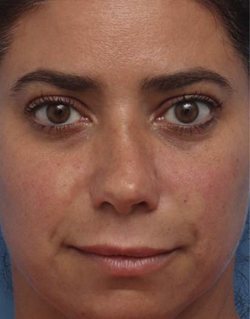 Revision Rhinoplasty Before & After Gallery - Patient 336611 - Image 3
