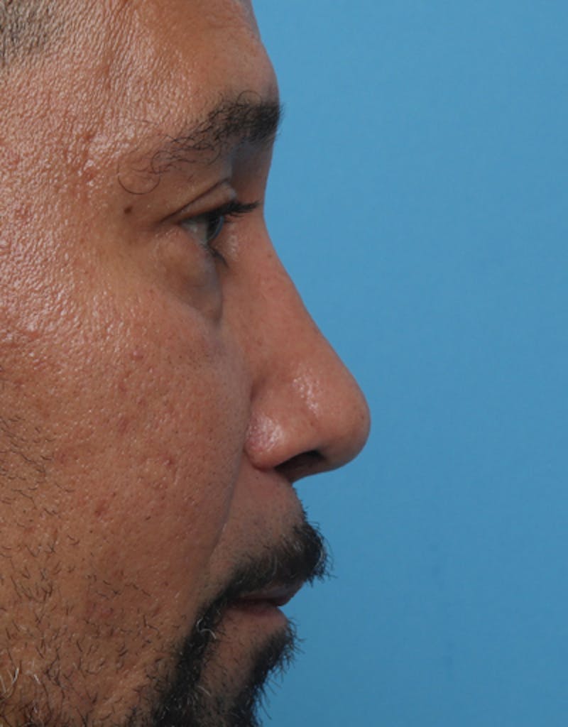 Male Rhinoplasty Before & After Gallery - Patient 263187 - Image 2