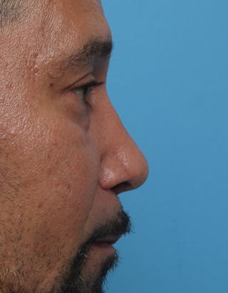 Rhinoplasty Before & After Gallery - Patient 325599 - Image 2
