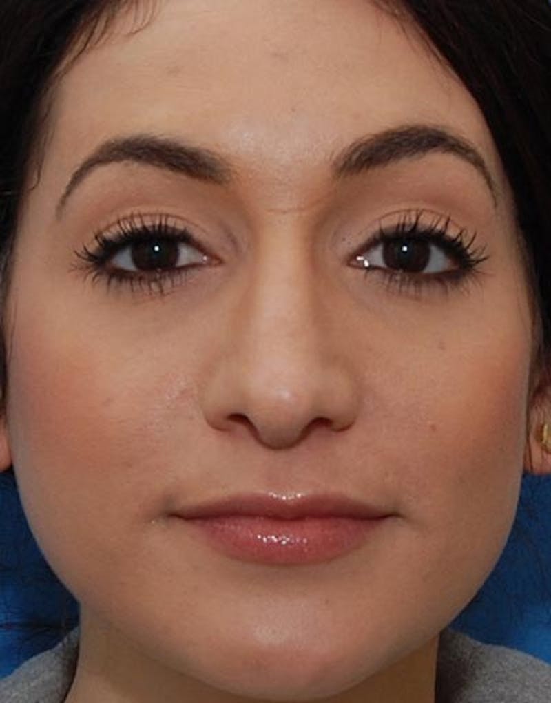 Rhinoplasty Before & After Gallery - Patient 347811 - Image 4