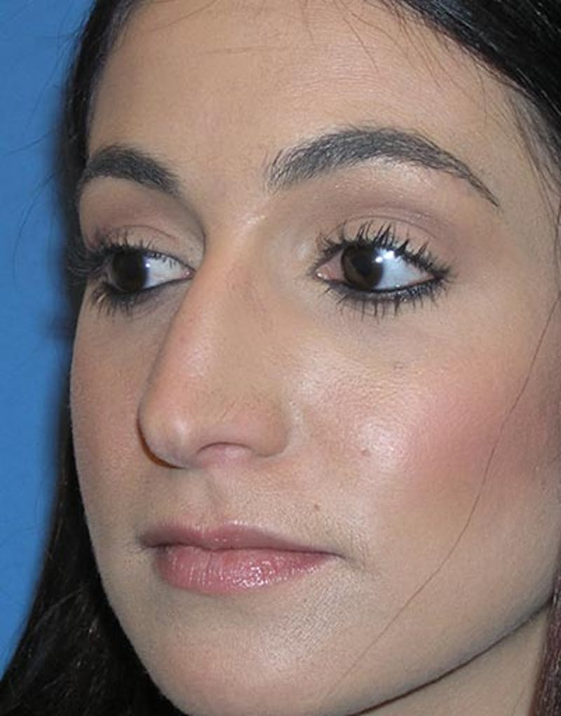 Rhinoplasty Before & After Gallery - Patient 347811 - Image 5