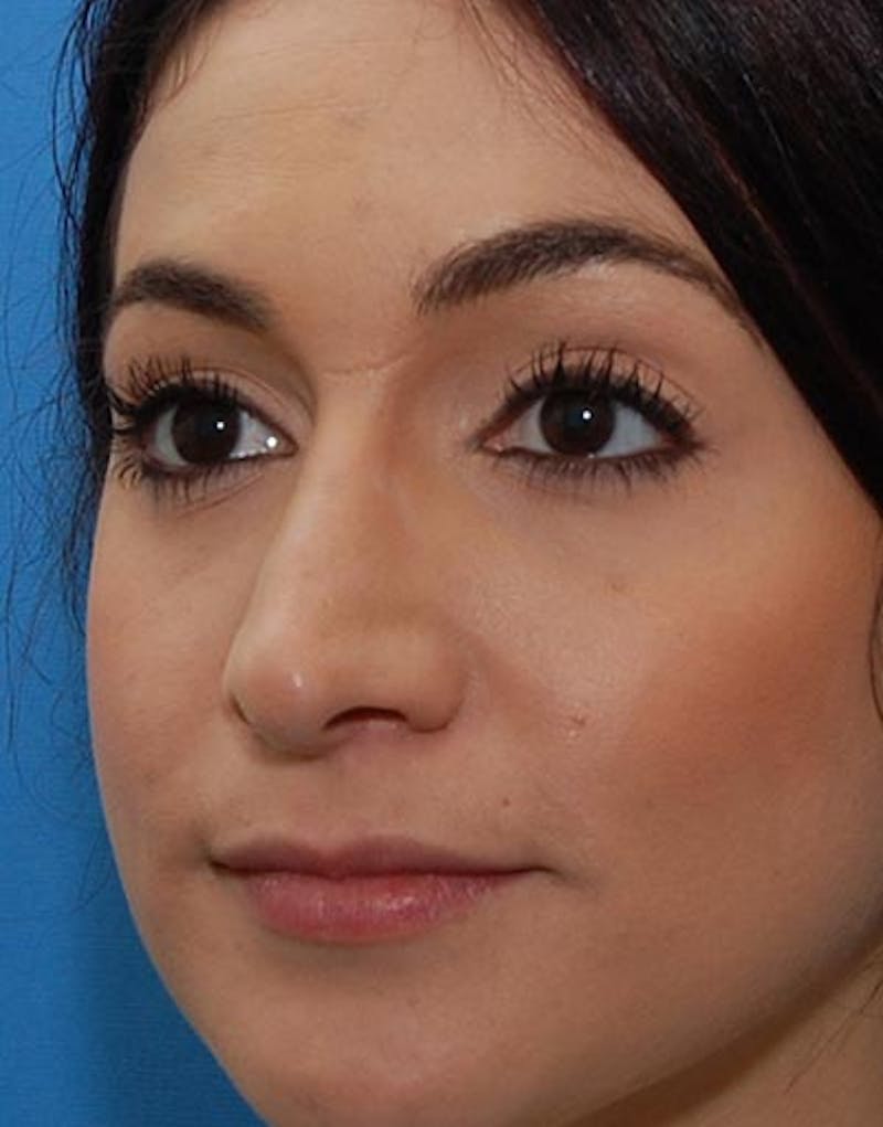 Rhinoplasty Before & After Gallery - Patient 347811 - Image 6