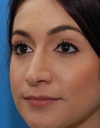 Rhinoplasty Before & After Gallery - Patient 199865 - Image 6