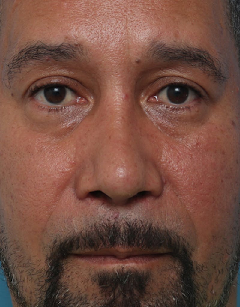 Rhinoplasty  Before & After Gallery - Patient 325599 - Image 4