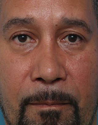 Rhinoplasty Before & After Gallery - Patient 325599 - Image 4