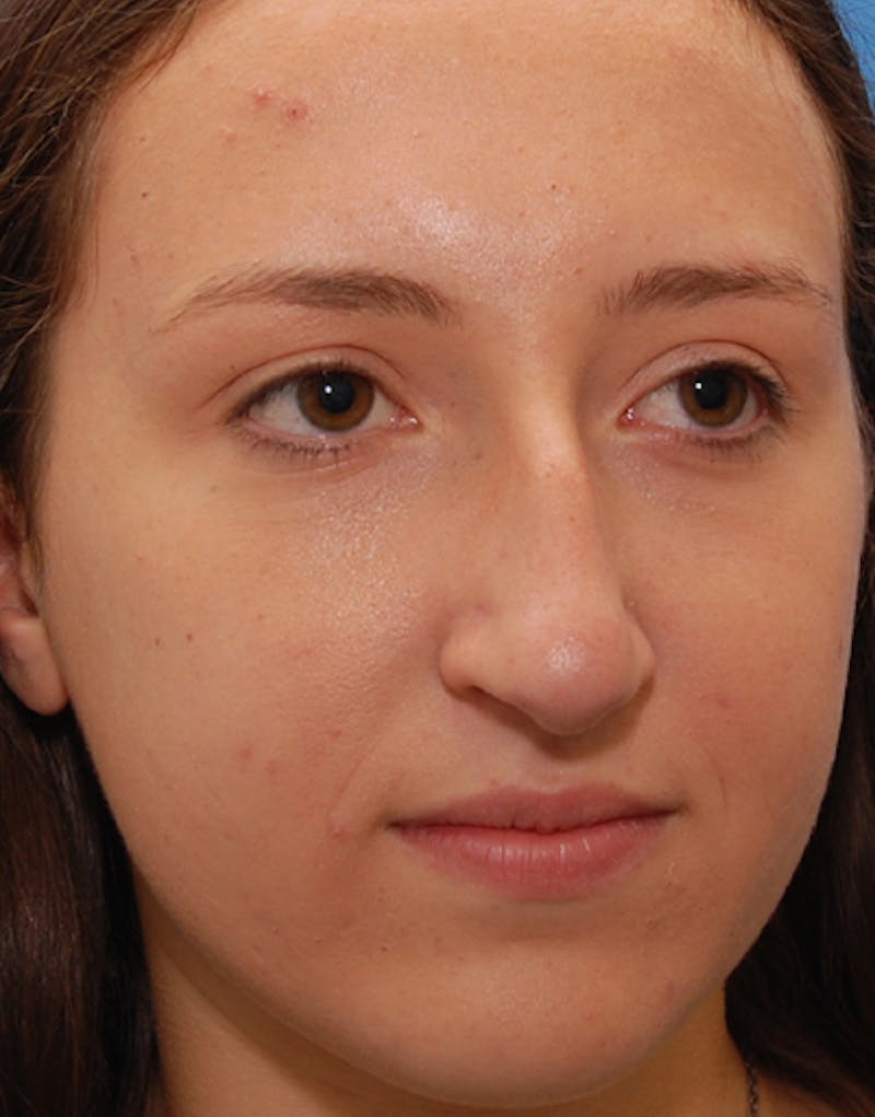 Rhinoplasty Before & After Gallery - Patient 347811 - Image 7