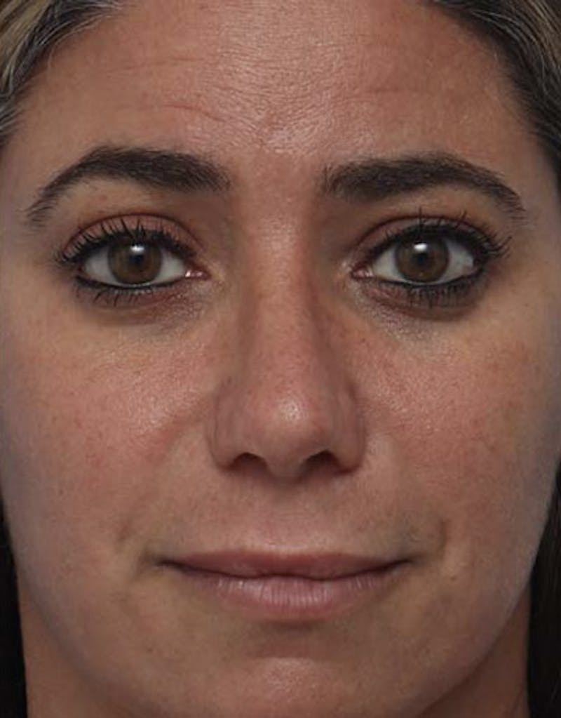 Revision Rhinoplasty Before & After Gallery - Patient 336611 - Image 4