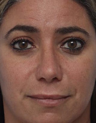 Rhinoplasty Before & After Gallery - Patient 113295 - Image 4