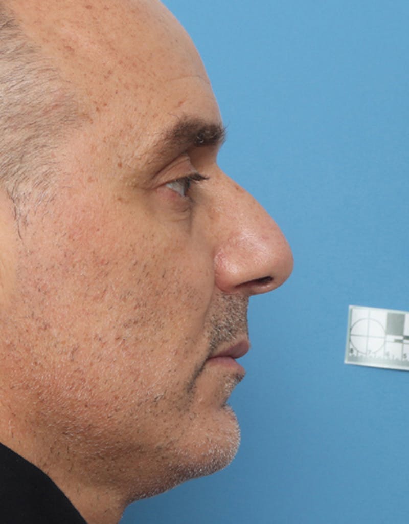 Patient Ip2jXs_HQpCLNjh-rGJTsw - Male Rhinoplasty Before & After Photos