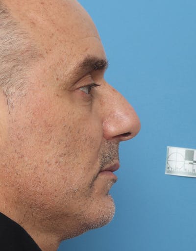 Rhinoplasty Before & After Gallery - Patient 301040 - Image 1