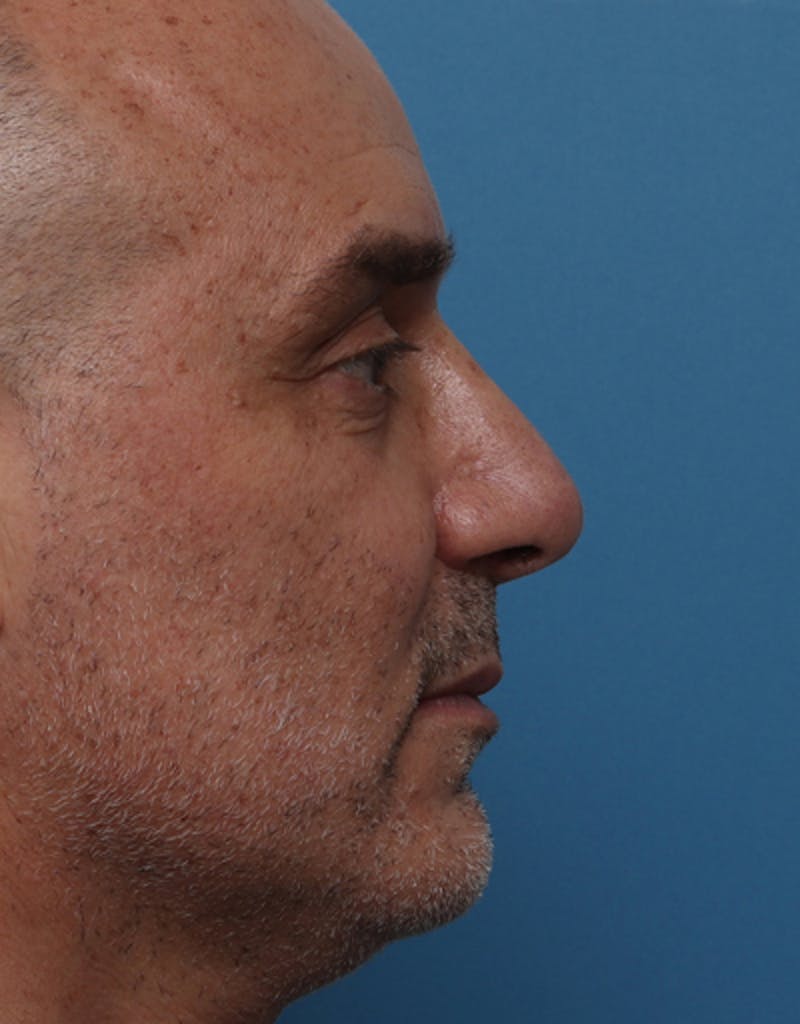 Male Rhinoplasty Before & After Gallery - Patient 248838 - Image 2